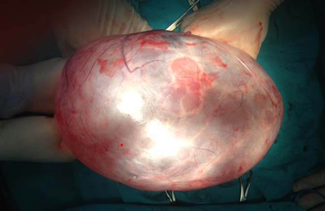 Biểu hiện của u nang buồng trứng ác tính