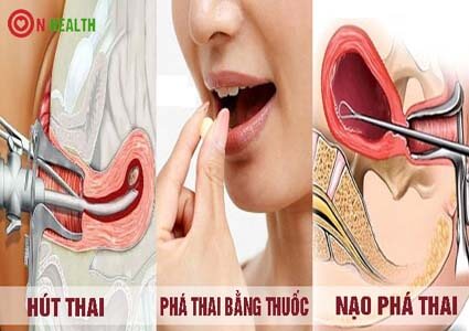 3 cách phá thai an toàn không đau và hồi phục sức khỏe nhanh