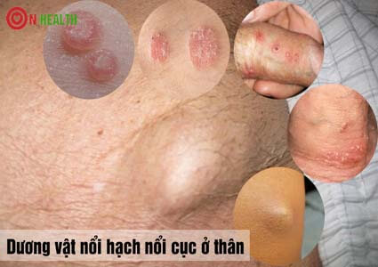 6 bệnh làm dương vật nổi hạch nổi cục ở thân