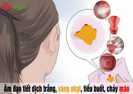 Âm đạo tiết dịch trắng vàng nhạt, tiểu buốt, chảy máu là bị bệnh gì?