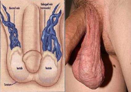 Bệnh giãn tĩnh mạch thừng tinh: Nguyên nhân, dấu hiệu, điều trị