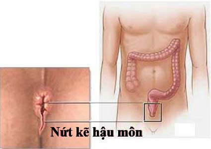 Bệnh nứt kẽ hậu môn