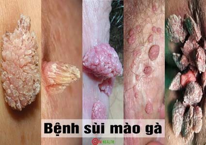 Bệnh sùi mào gà ở nam nữ: Nguyên nhân, triệu chứng, cách chữa
