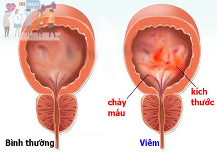 Bệnh viêm bàng quang - Bệnh nhiễm trùng đường tiết niệu