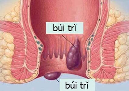 Bị bệnh trĩ có biến chứng thành ung thư trực tràng không?