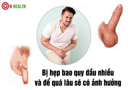 Bị hẹp bao quy đầu là gì? Để vậy có sao không?
