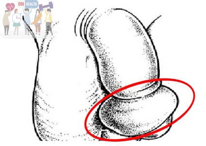 Bị rát, phù nề sau khi cắt bao quy đầu bao lâu thì hết