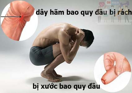 Bị Xước, Bị Rách Bao Quy Đầu Phải Làm Sao
