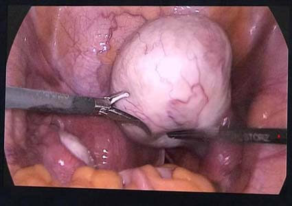 Biểu hiện của u nang buồng trứng ác tính, siêu âm có phát hiện?