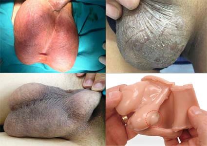 Các Bệnh Tinh Hoàn Gây Sưng, Nhức, Ngứa
