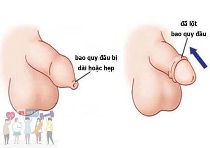 Cách tự [Lột Bao Quy Đầu] dài hoặc hẹp tại nhà an toàn