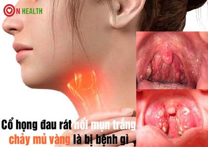 Cổ họng đau rát nổi mụn trắng và chảy mủ vàng là bị bệnh gì?