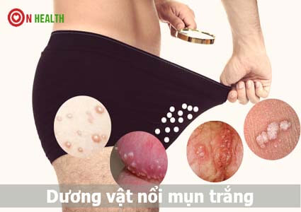 Da dương vật nổi mụn trắng không ngứa có sao không? Cách chữa
