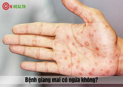 Dấu hiệu bệnh giang mai có ngứa không? có chữa được không?