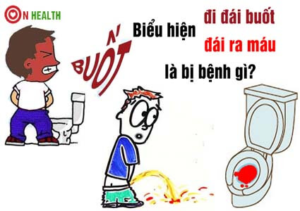 Biểu hiện đi đái buốt ra máu nhiều là bị bệnh gì và cách chữa triệt để
