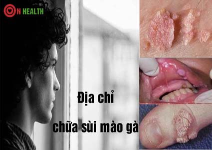Top 20 địa chỉ khám chữa bệnh sùi mào gà ở đâu tốt nhất Hà Nội