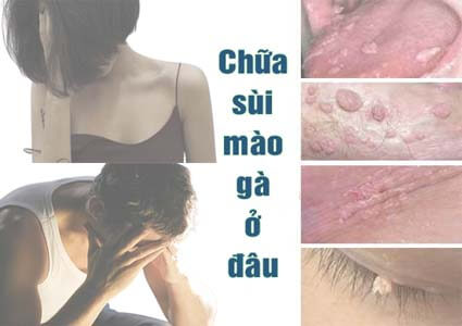 Top 15 địa chỉ khám chữa sùi mào gà ở đâu Hà Nội tốt nhất uy tín