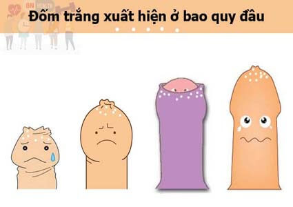 Đốm trắng xuất hiện ở bao quy đầu là bị làm sao? Bệnh gì?