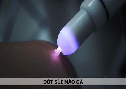 Đốt sùi mào gà bao lâu thì khỏi và lành hẳn, có đau không?