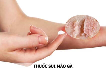 Dùng thuốc sùi mào gà có chữa trị khỏi bệnh không