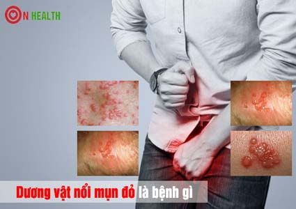 Dương vật nổi mụn đỏ là bệnh gì? Nổi mẩn đỏ ngứa hoặc không ngứa