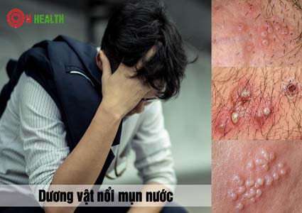Dương vật bị nổi mụn nước ngứa là bệnh gì? Cách chữa an toàn