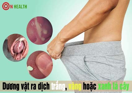 Dương vật ra dịch trắng vàng hoặc xanh lá cây là dấu hiệu bị bệnh gì?