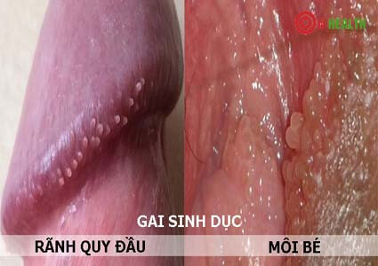 Gai sinh dục ở môi bé nữ, rãnh quy đầu nam