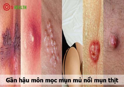 Gần hậu môn mọc mụn mủ nổi mụn thịt là bị bệnh gì?