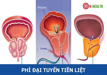 Kích thước phì đại tuyến tiền liệt và chi phí mổ điều trị
