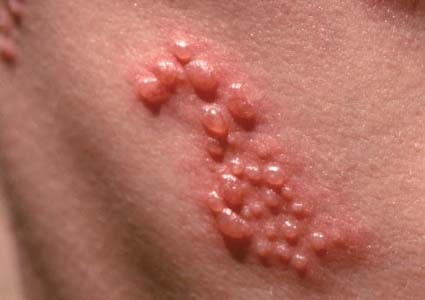 Mụn rộp sinh dục (Herpes): Triệu chứng, Chẩn đoán, Hình ảnh