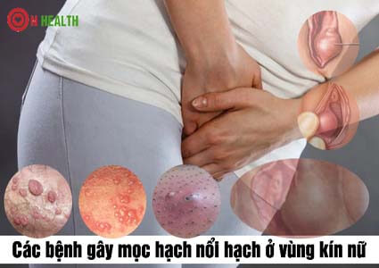 Bị nổi hạch ở mép vùng kín nữ (đau, cứng, có mủ)