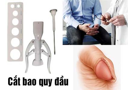 Cắt bao quy đầu là gì? Quy trình phẫu thuật bao quy đầu