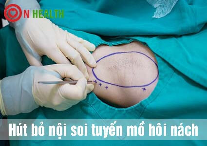 Top 3 địa chỉ chữa hôi nách cắt tuyến mồ hôi nách ở đâu tốt nhất