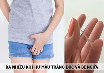 Ra nhiều khí hư màu trắng đục và ngứa là bị gì? Cách chữa trị