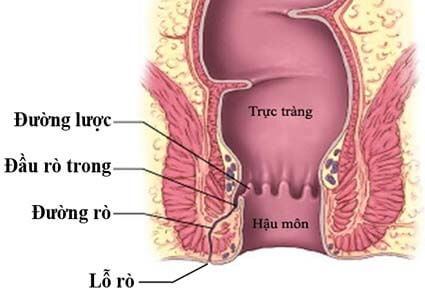 Bệnh rò hậu môn