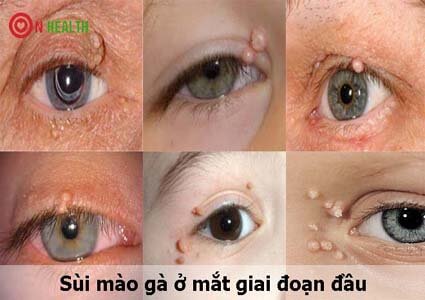 Sùi Mào Gà Ở Mắt Giai Đoạn Đầu Có Nguy Hiểm Không?