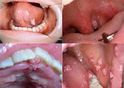 Sùi mào gà ở miệng, lưỡi, họng: Triệu chứng, hình ảnh và chẩn đoán