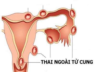 Thai Ngoài Tử Cung: nguyên nhân, biểu hiện, cách điều trị