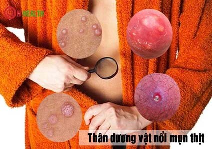 5 bệnh làm thân dương vật nổi mụn thịt đỏ không ngứa