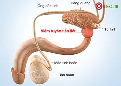 Triệu chứng bị viêm tuyến tiền liệt và cách chữa tốt nhất