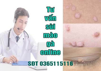 Tư vấn sùi mào gà online và qua sđt 0365115116 miễn phí