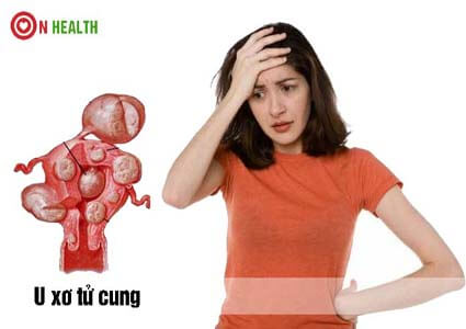 U Xơ Tử Cung Bệnh Học Là Gì? Dấu Hiệu Và Cách Chữa