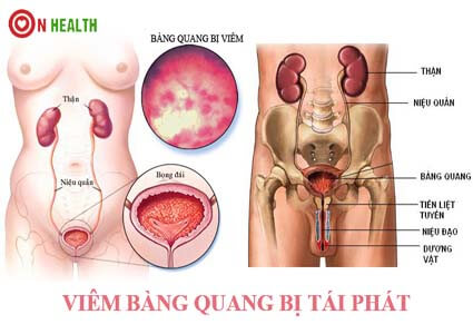Viêm bàng quang bị tái phát, nguyên nhân và cách phòng ngừa