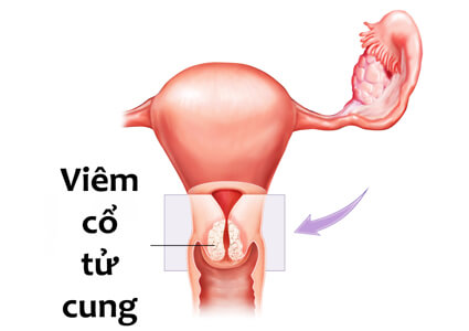 Chẩn Đoán Và Điều Trị Viêm Cổ Tử Cung