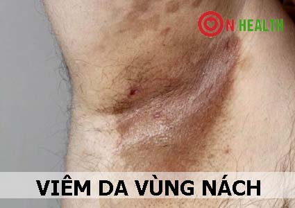Viêm da vùng nách bị nổi hột đỏ ngứa và rát, dị ứng ở nách