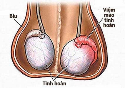 Viêm mào tinh hoàn: Triệu chứng, nguyên nhân, chẩn đoán, điều trị