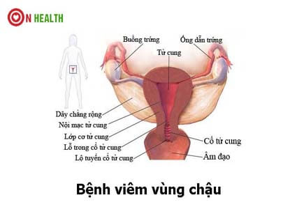 Viêm vùng chậu: Cách chẩn đoán dấu hiệu bệnh và chi phí chữa trị