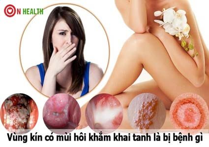 Tại sao vùng kín có mùi hôi khắm khai tanh? Là bị bệnh gì