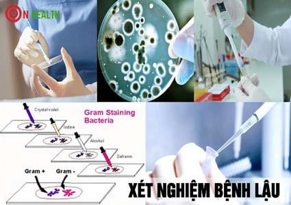 Xét nghiệm lậu bằng cách nào và sau bao lâu sẽ có kết quả?